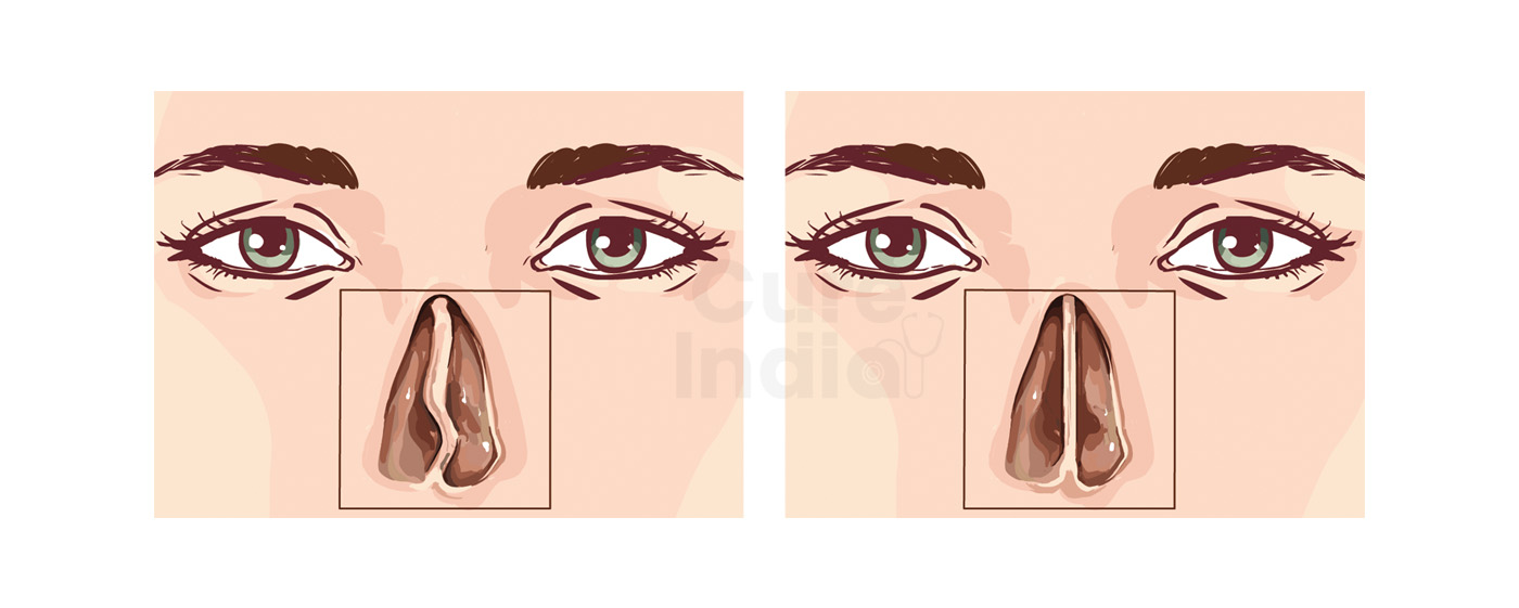 Nasal Septum Surgery